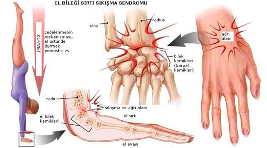 Sinir Sikismasi Tedavisi